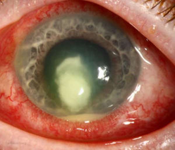 фото грибкового кератита глаза